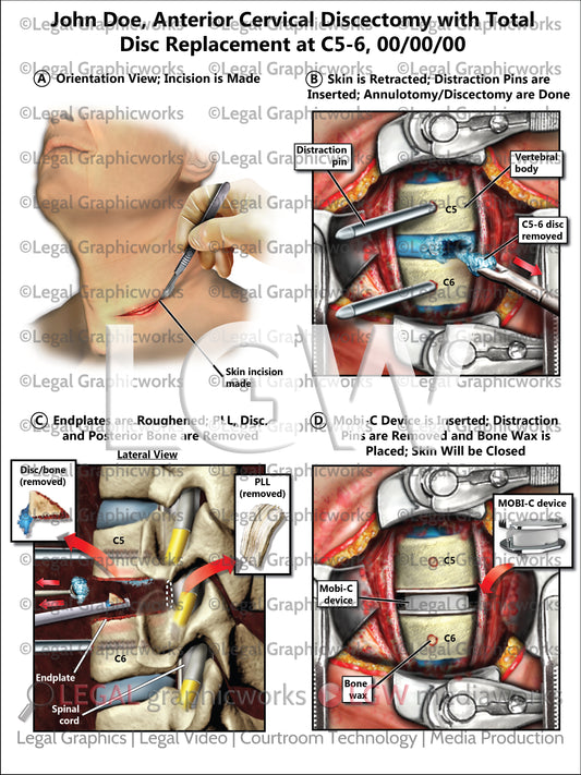 Anterior Cervical Discectomy with Total Disc Replacement at C5-6
