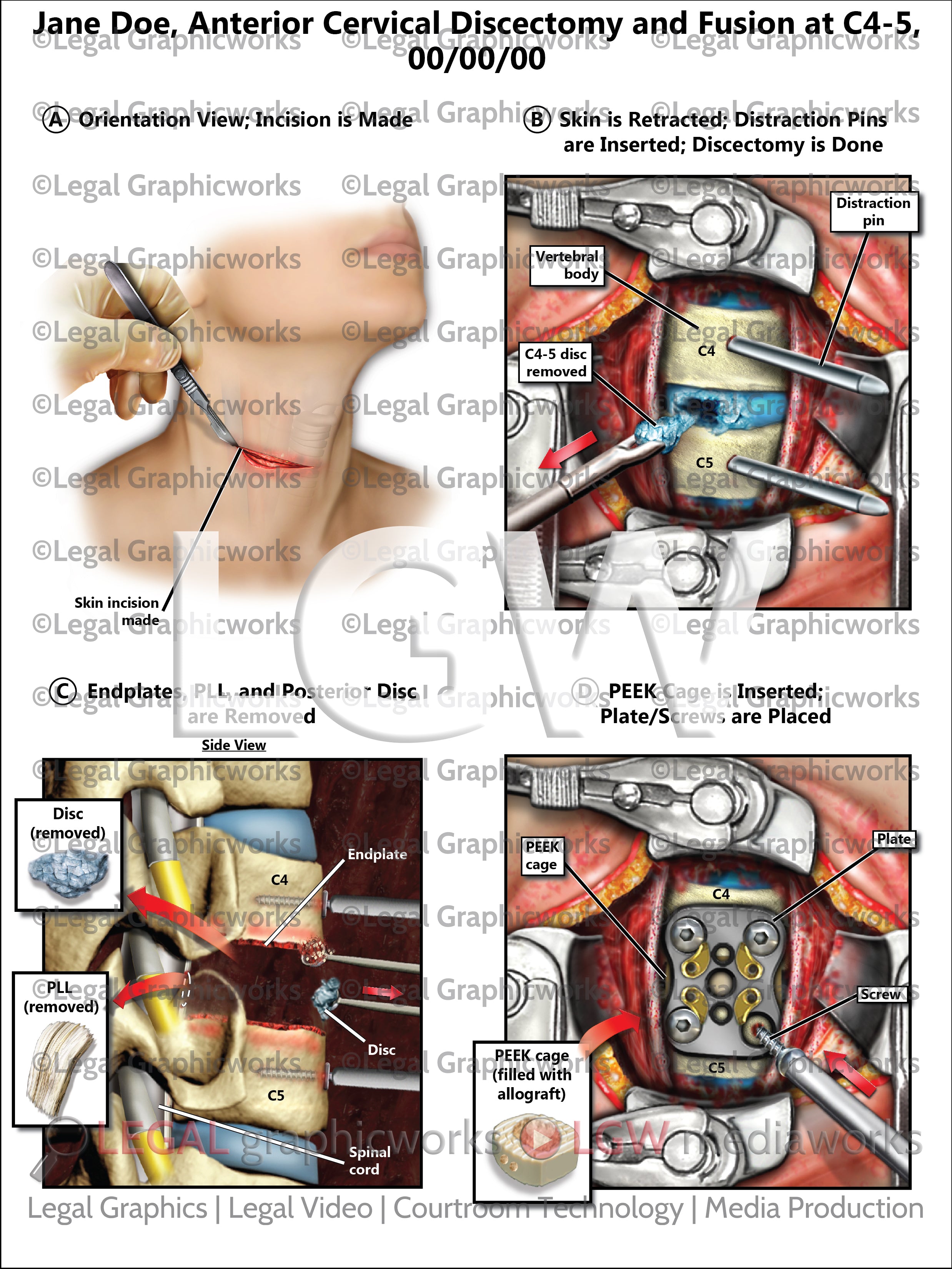 Disccectomy Anterior Cervical Discectomy and Fusion at C4-5 – LGWgo