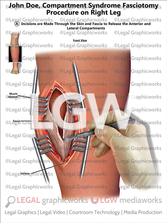 Compartment Syndrome Fasciotomy Procedure on Right Leg