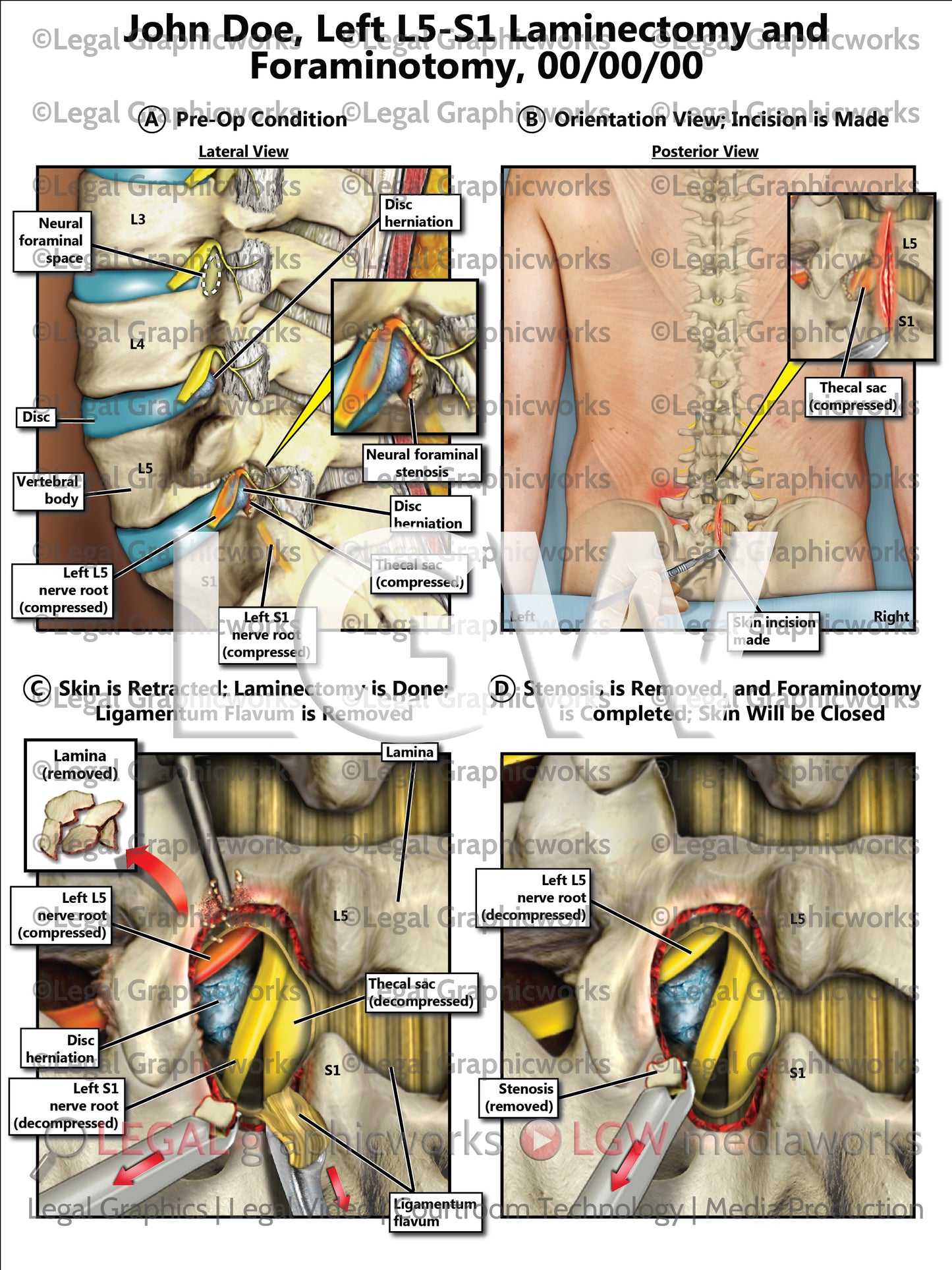Left L5-S1 Laminectomy and Foraminotomy