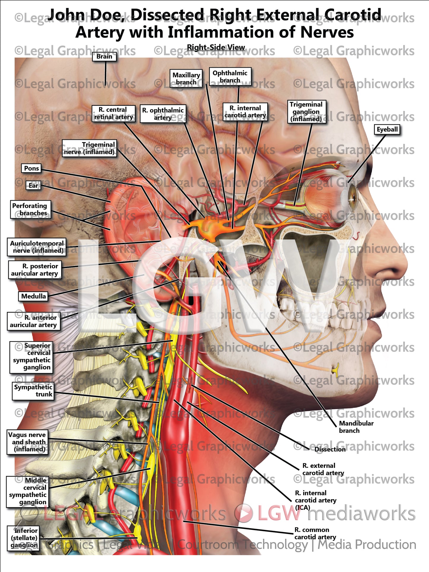 Dissected Right External Carotid Artery with Inflammation of Nerves