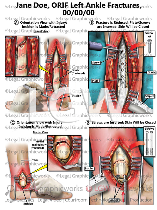 ORIF Left Ankle Fractures