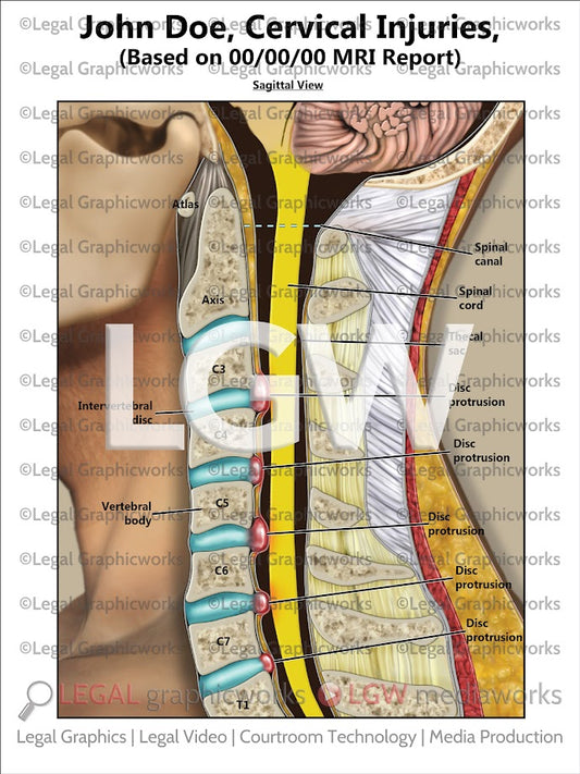 Cervical Injuries