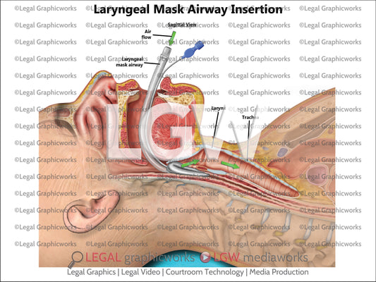 Laryngeal Mask Airway Insertion