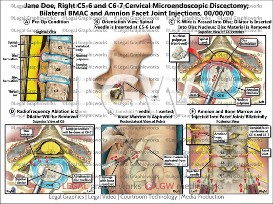 Right C5-6 and C6-7 Cervical Microendoscopic Discectomy; Bilateral BMAC and Amnion Facet Joint Injections