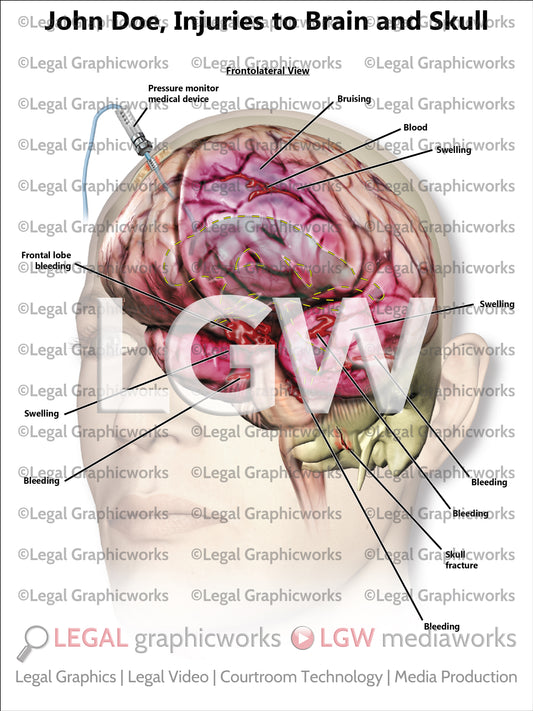 Injuries to Brain and Skull