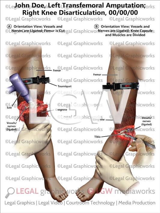 Left Transfemoral Amputation Right Knee Disarticulation