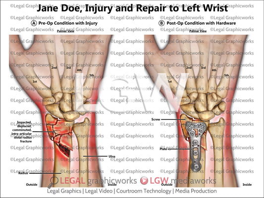 Injury and Repair to Left Wrist