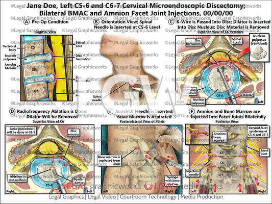 Left C5-6 and C6-7 Cervical Microendoscopic Discectomy; Bilateral BMAC and Amnion Facet Joint Injections