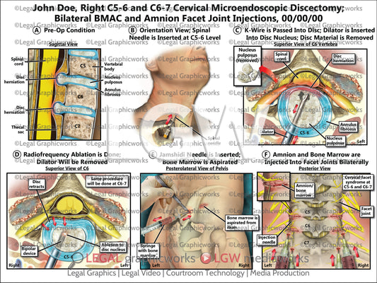 Right C5-6 and C6-7 Cervical Microendoscopic Discectomy; Bilateral BMAC and Amnion Facet Joint Injections