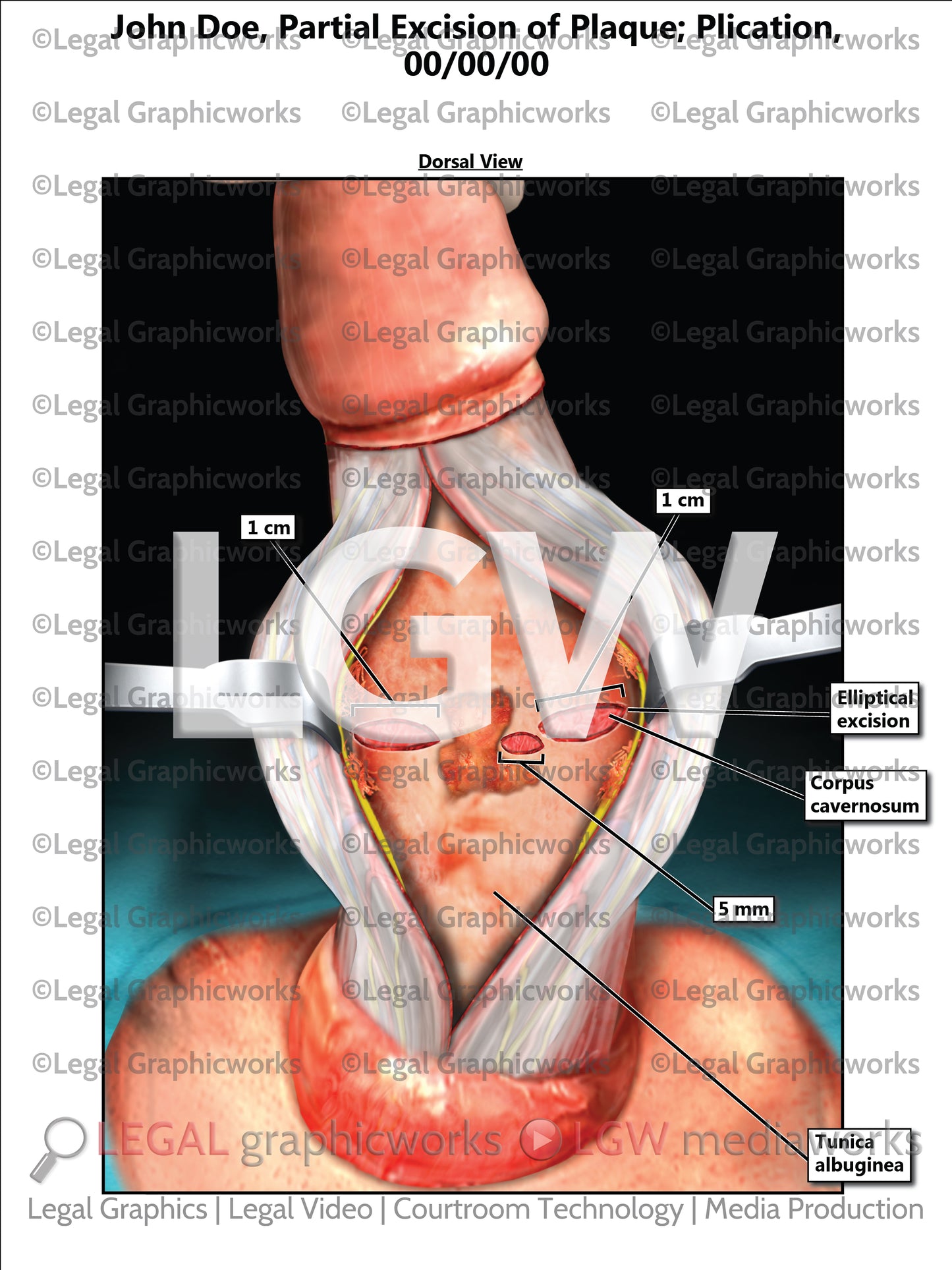 Partial Excision of Plaque; Plication