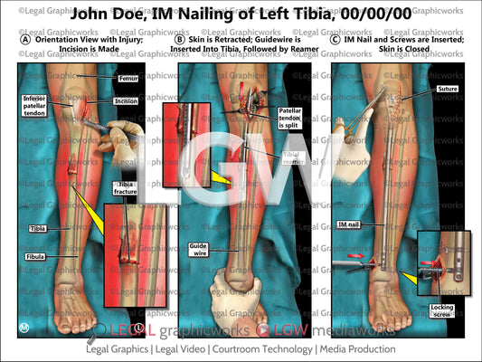 IM Nailing of Left Tibia