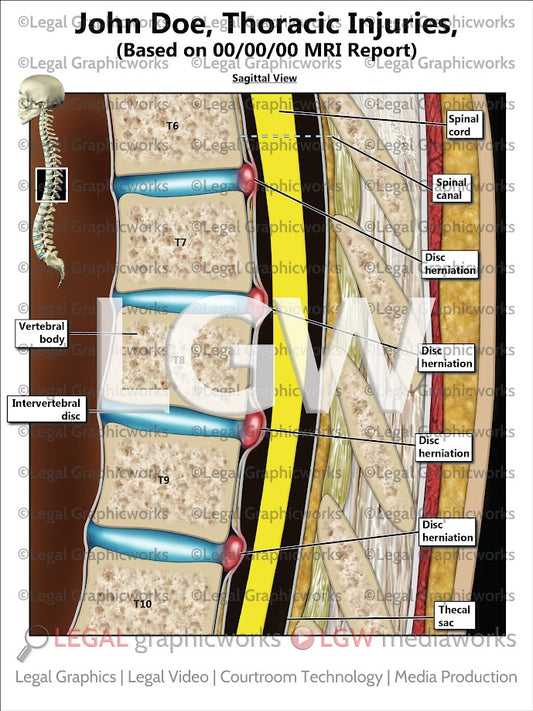 Thoracic Injuries