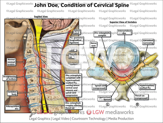 Condition of Cervical Spine