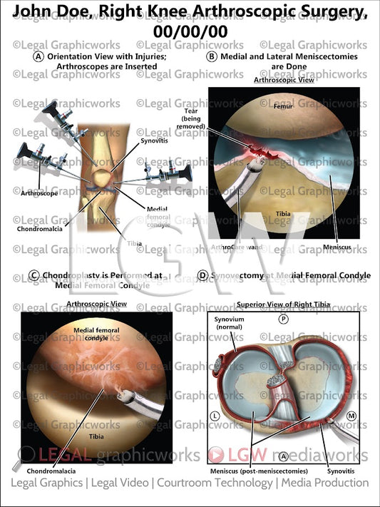 Right Knee Arthroscopic Surgery