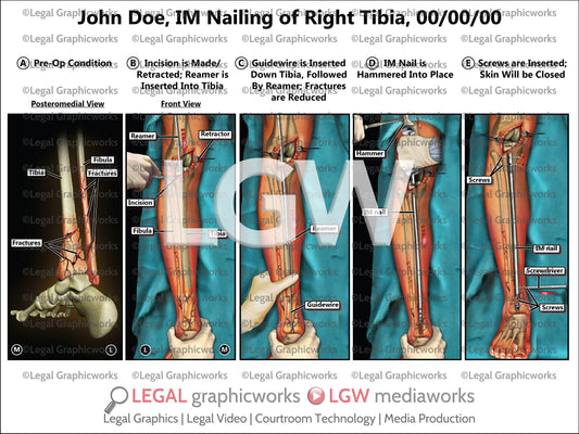 IM Nailing of Right Tibia