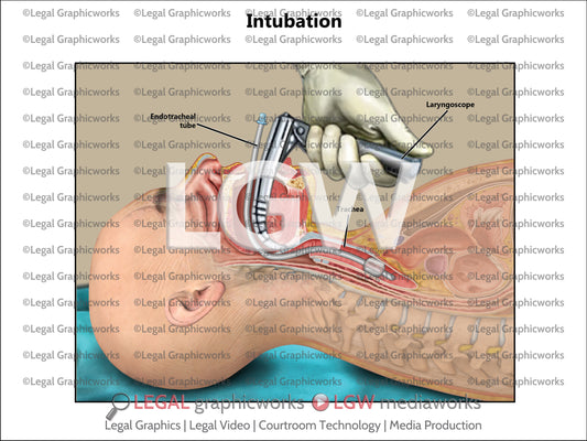 Intubation