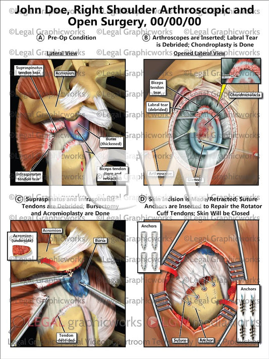Right Shoulder Arthroscopic and Open Surgery