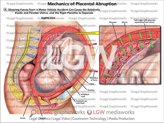 Mechanics of Placental Abruption