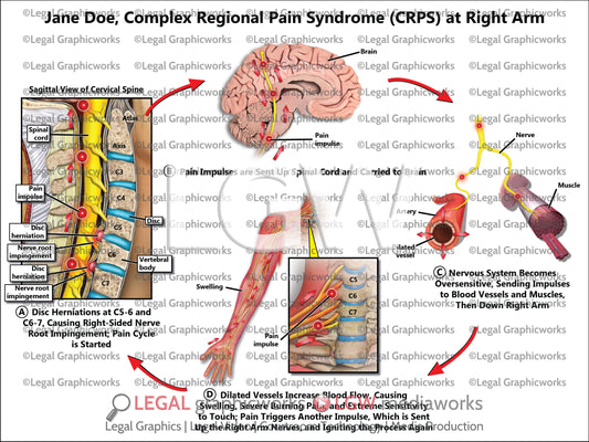 Complex Regional Pain Syndrome (CRPS) at Right Arm