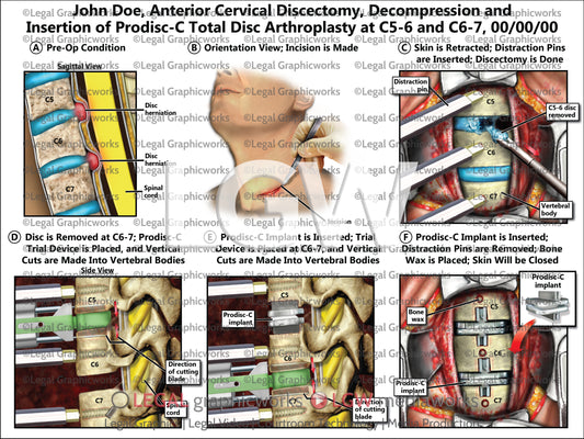 Anterior Cervical Discectomy, Decompression and Insertion of Prodisc-C Total Disc Arthroplasty at C5-6 and C6-7