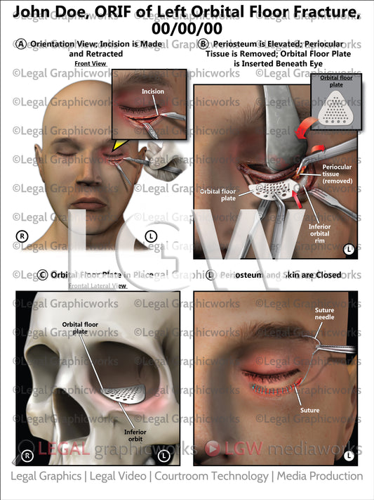 ORIF of Left Orbital Floor Fracture