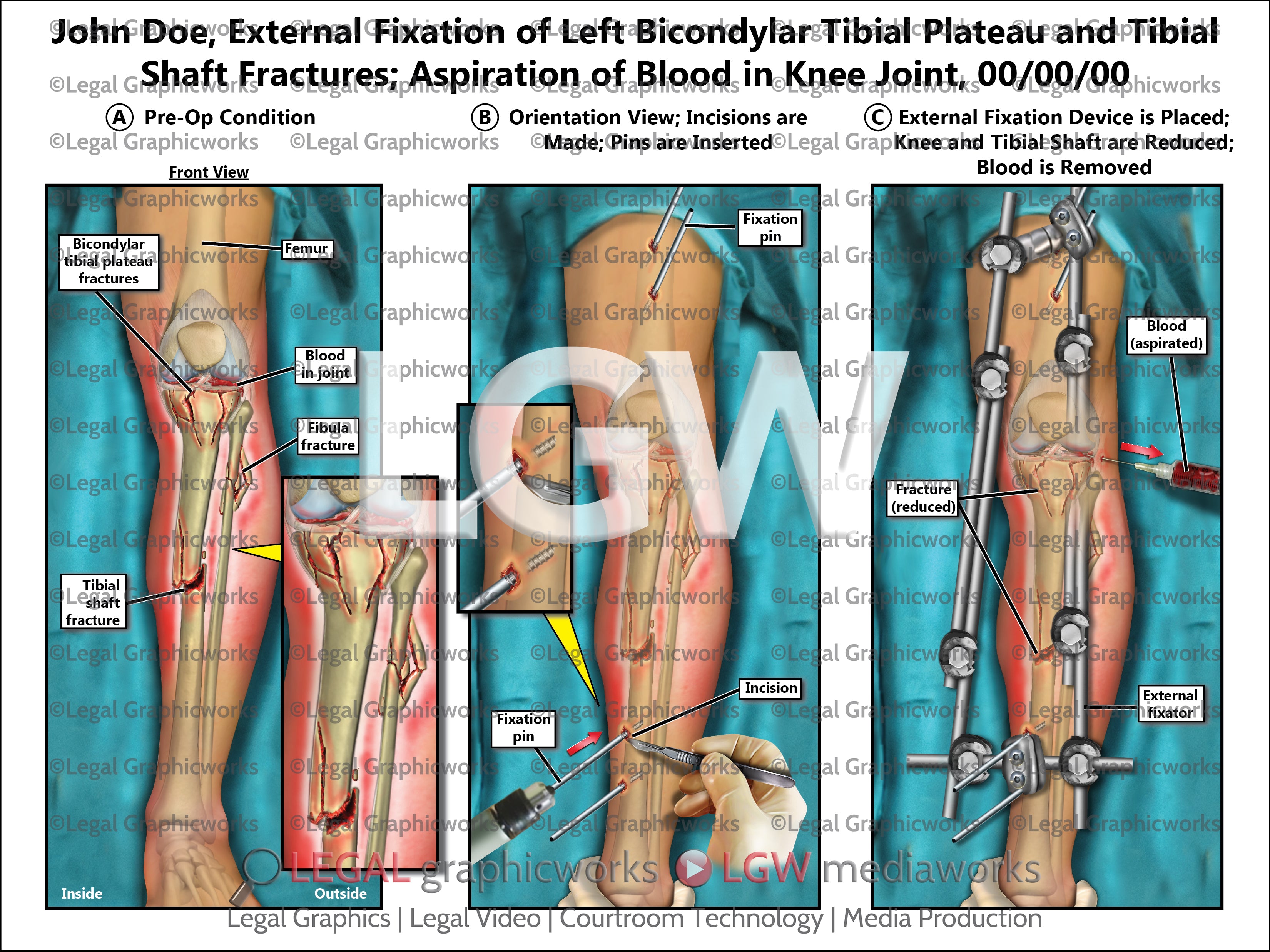 External Fixation of Left Bicondylar Tibial Plateau and Tibial Shaft F ...
