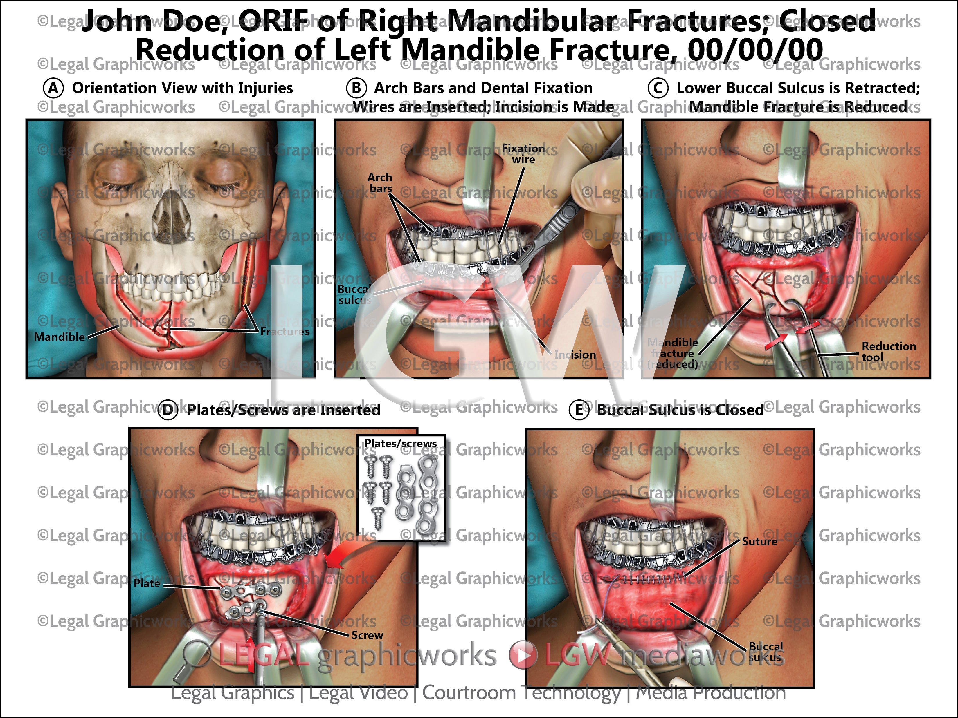 ORIF of Right Mandibular Fractures; Closed Reduction of Left Mandible ...