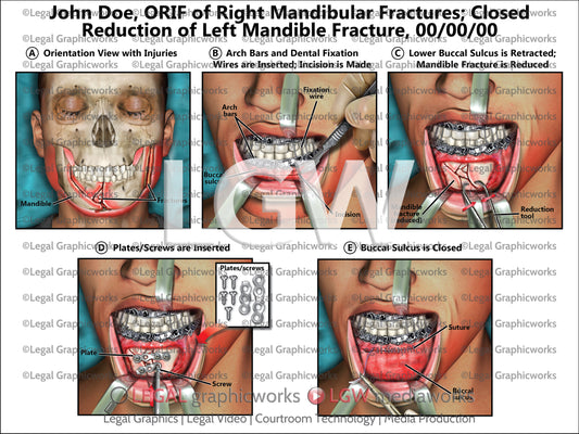 ORIF of Right Mandibular Fractures; Closed Reduction of Left Mandible Fracture