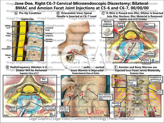 Right C6-7 Cervical Microendoscopic Discectomy; Bilateral BMAC and Amnion Facet Joint Injections at C5-6 and C6-7