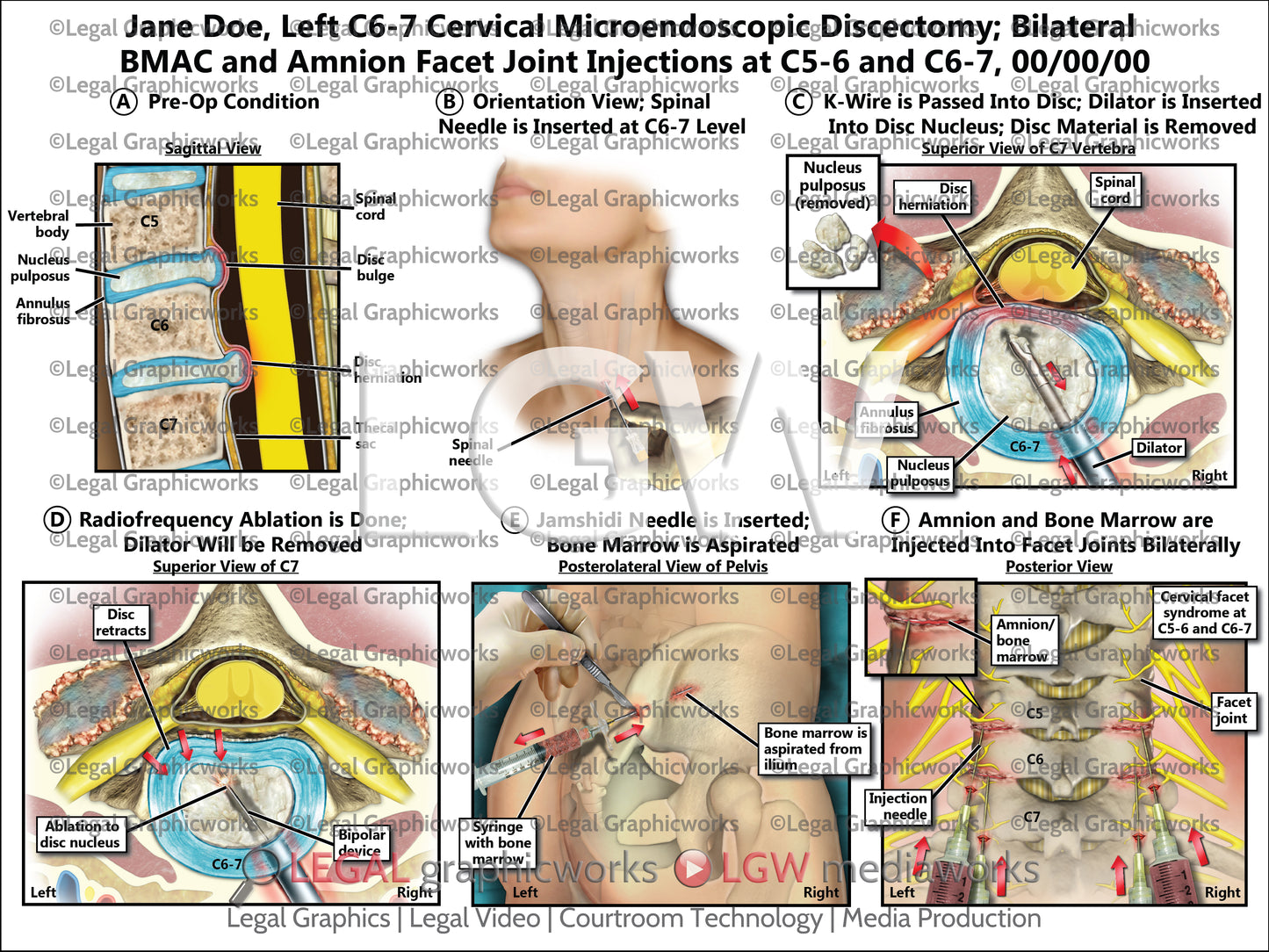 Left C6-7 Cervical Microendoscopic Discectomy; Bilateral BMAC and Amnion Facet Joint Injections at C5-6 and C6-7