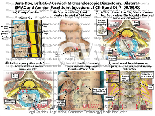 Left C6-7 Cervical Microendoscopic Discectomy; Bilateral BMAC and Amnion Facet Joint Injections at C5-6 and C6-7