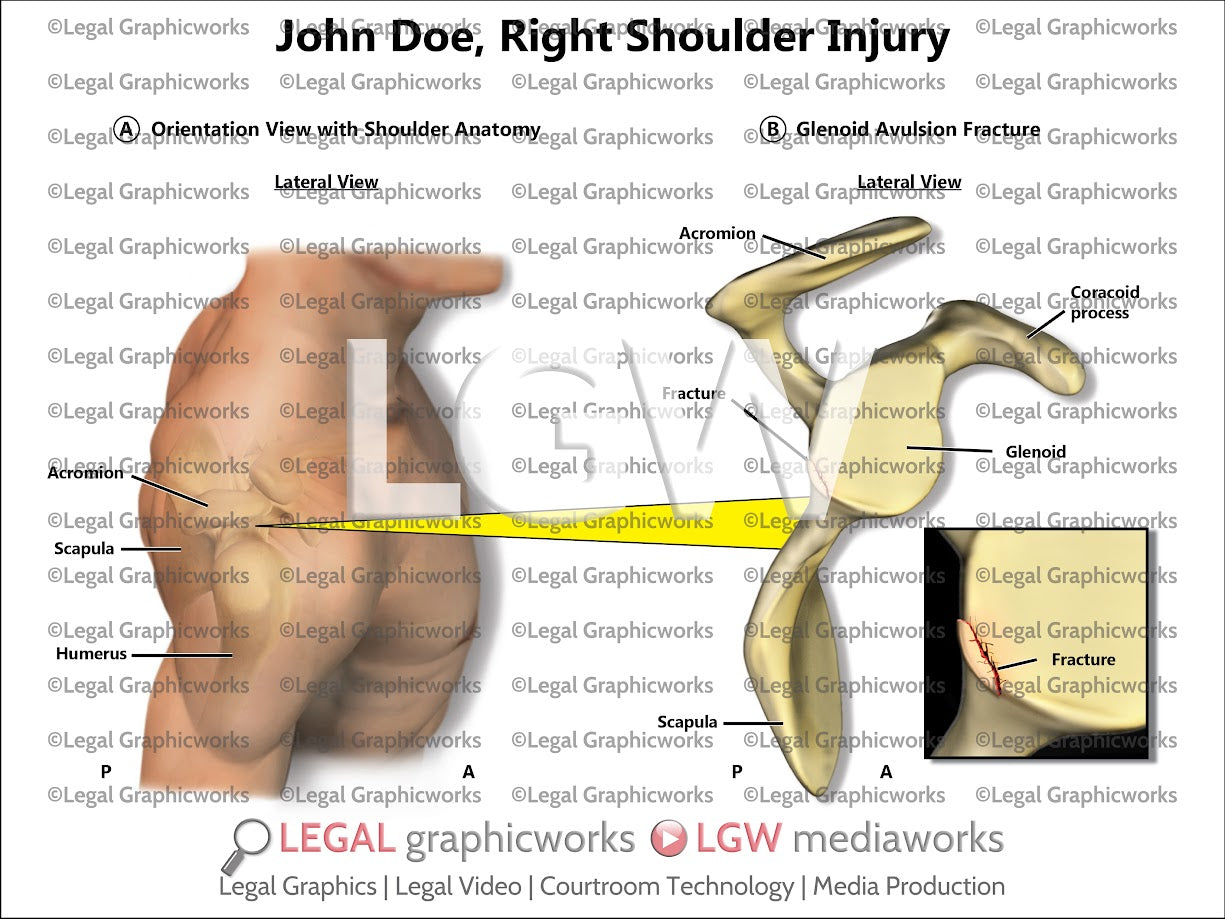Right Shoulder Injury