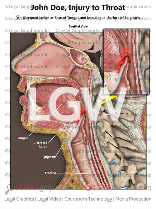 Injury to Throat