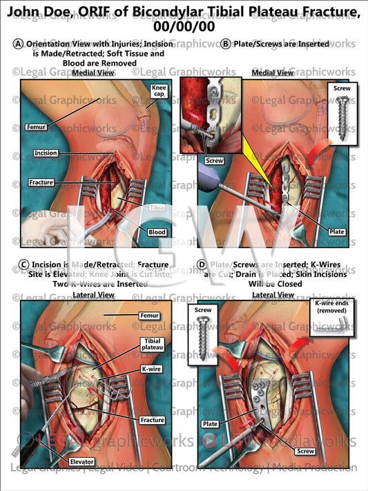 ORIF of Bicondylar Tibial Plateau Fracture