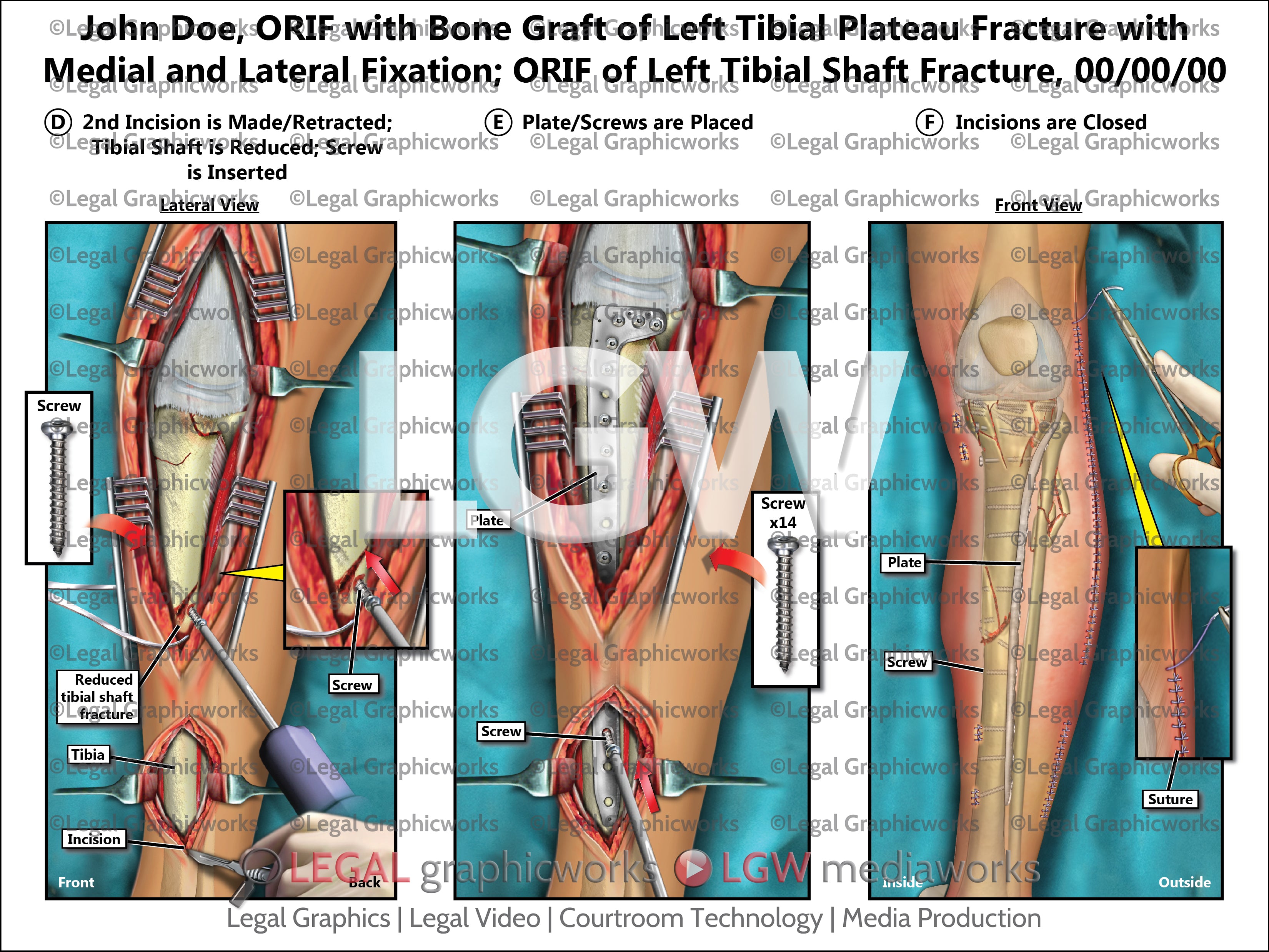 ORIF with Bone Graft of Left Tibial Plateau Fracture with Medial and L ...