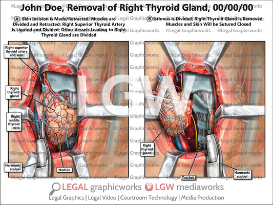Removal of Right Thyroid Gland