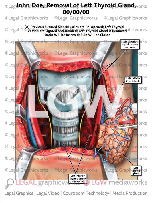 Removal of Left Thyroid Gland