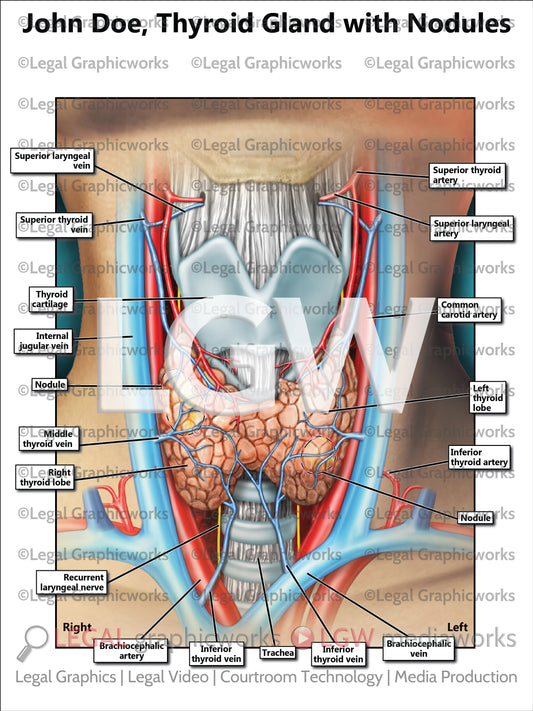Thyroid Gland with Nodules