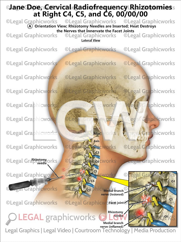 Cervical Radiofrequency Rhizotomies at Right C4, C5, and C6