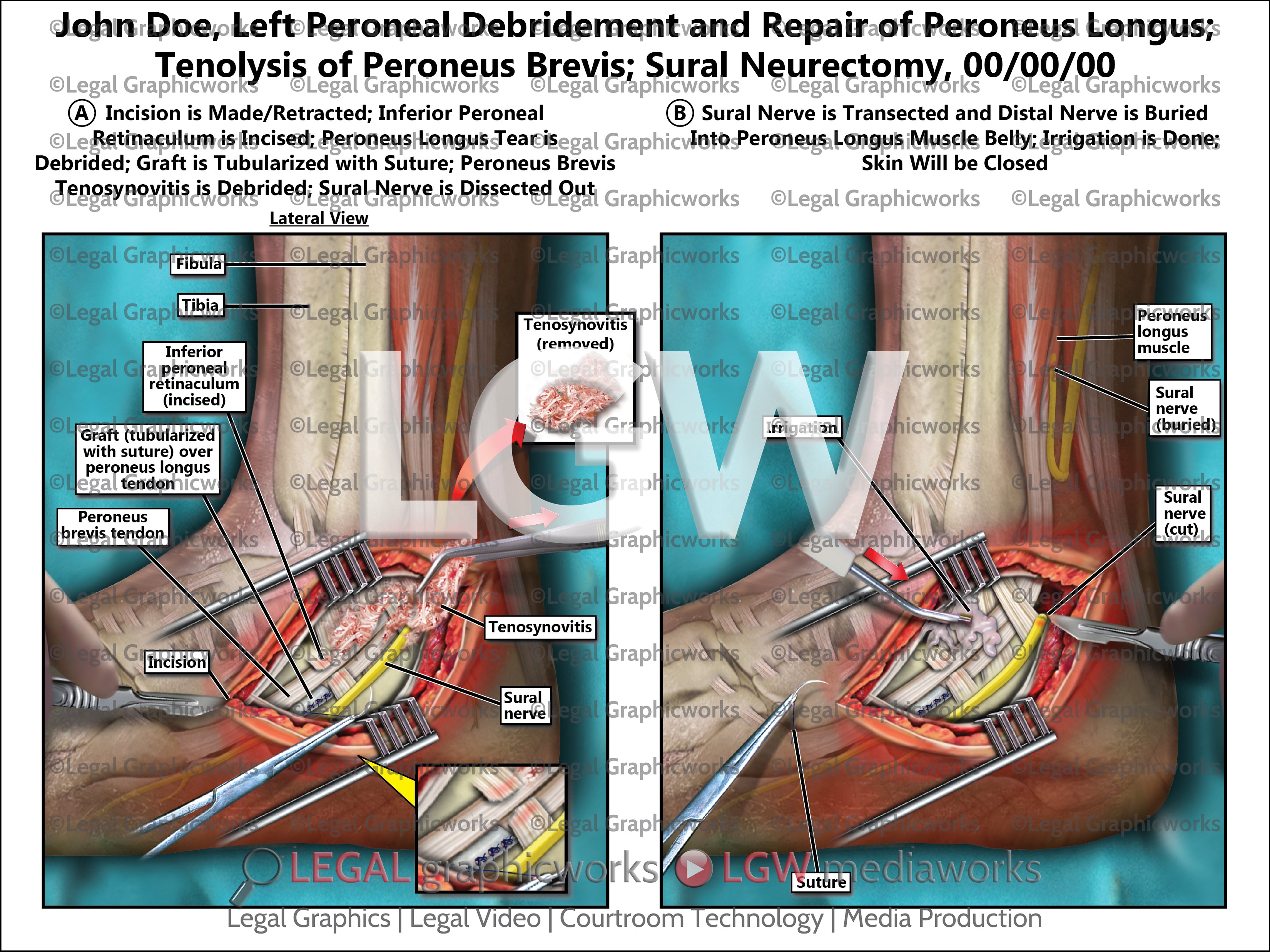 Tynolysis Left Peroneal Debridement and Repair of Peroneus Longus; Tenolysis of ...