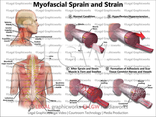Myofascial Sprain and Strain