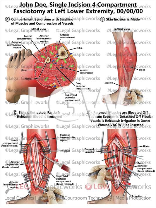 Single Incision 4 Compartment Fasciotomy at Left Lower Extremity