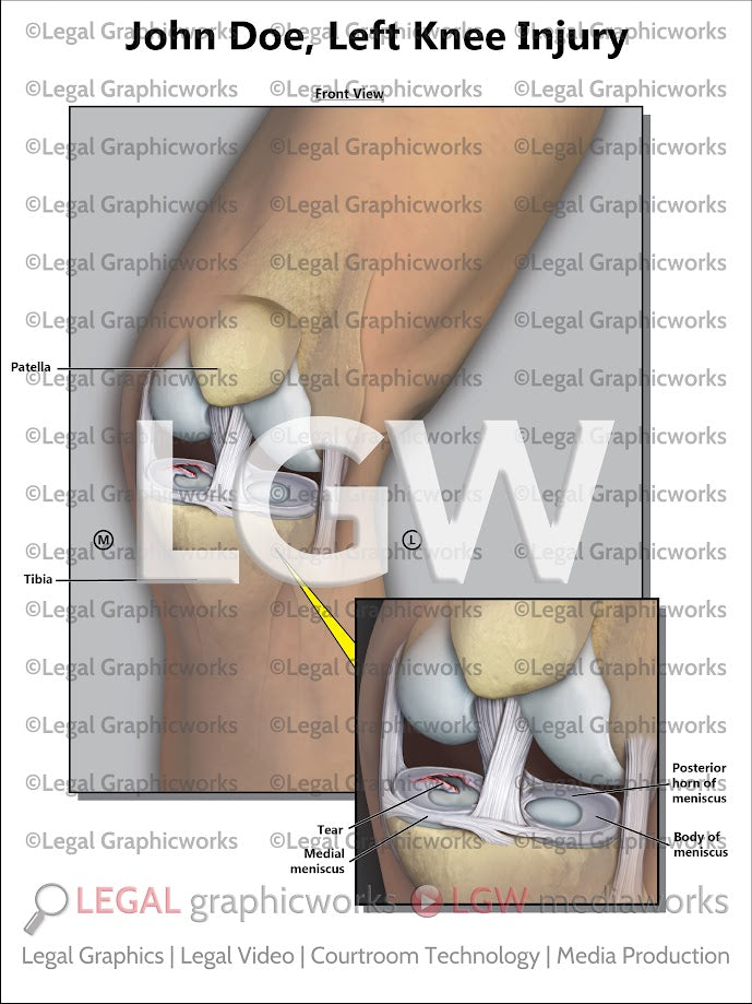 Left Knee Injury
