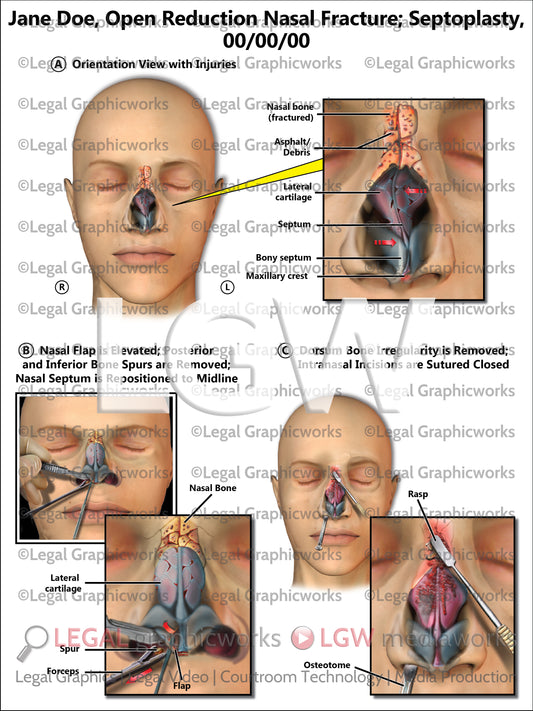 Open Reduction Nasal Fracture; Septoplasty