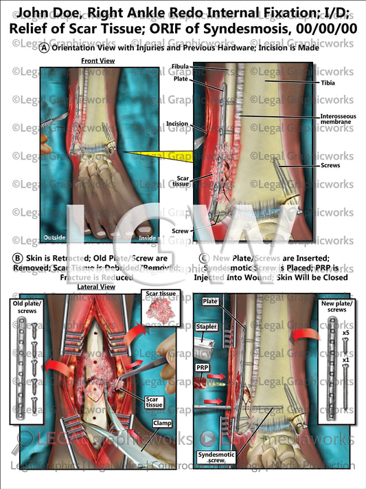 Right Ankle Redo Internal Fixation; I/D; Relief of Scar Tissue; ORIF of Syndesmosis