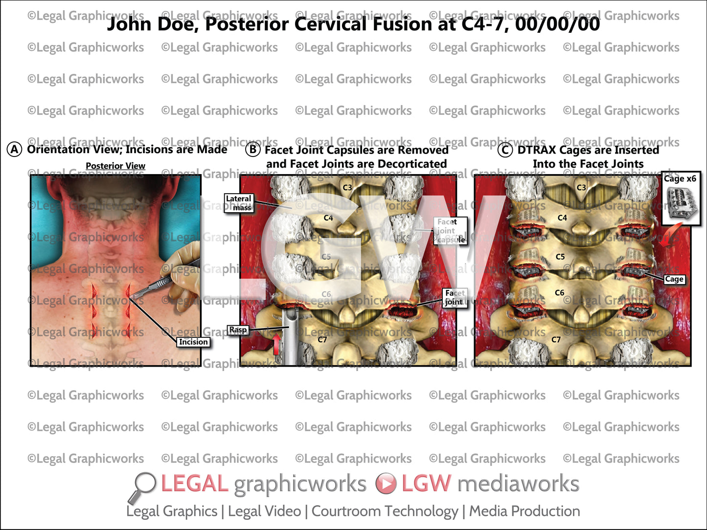 Posterior Cervical Fusion at C4-7