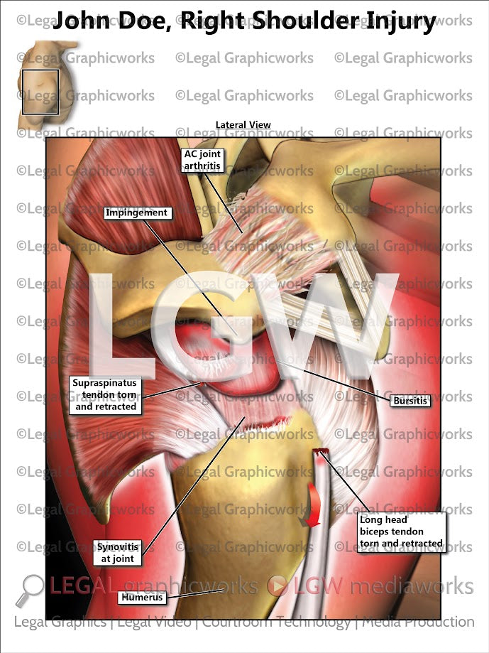 Right Shoulder Injury