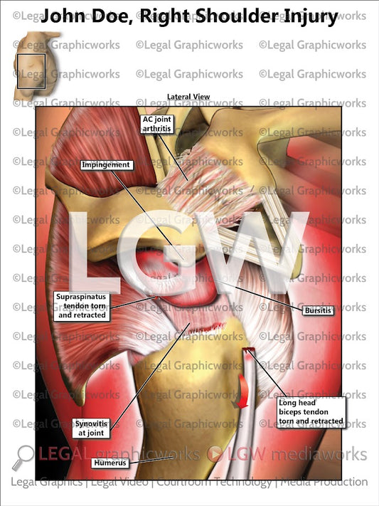 Right Shoulder Injury