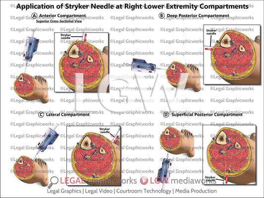 Application of Stryker Needle at Right Lower Extremity Compartments